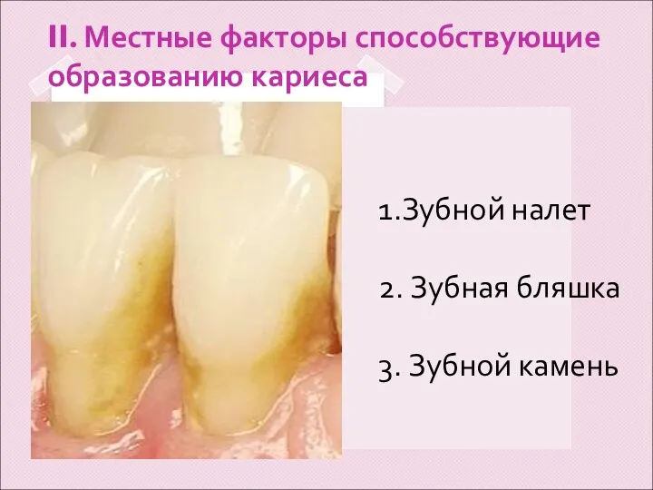 II. Местные факторы способствующие образованию кариеса 1.Зубной налет 2. Зубная бляшка 3. Зубной камень