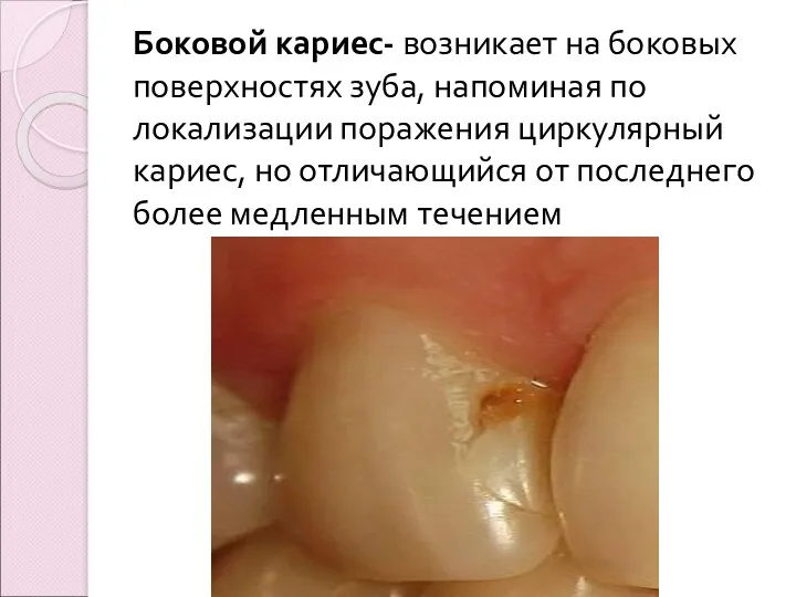 Боковой кариес- возникает на боковых поверхностях зуба, напоминая по локализации поражения циркулярный кариес,