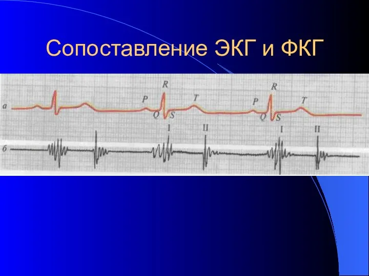 Сопоставление ЭКГ и ФКГ