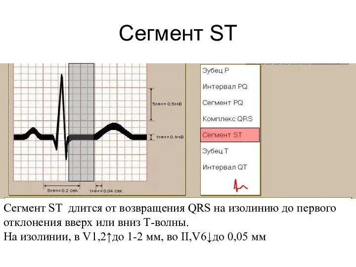 Сегмент ST Сегмент ST длится от возвращения QRS на изолинию