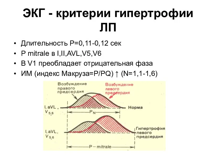 ЭКГ - критерии гипертрофии ЛП Длительность Р=0,11-0,12 сек P mitrale