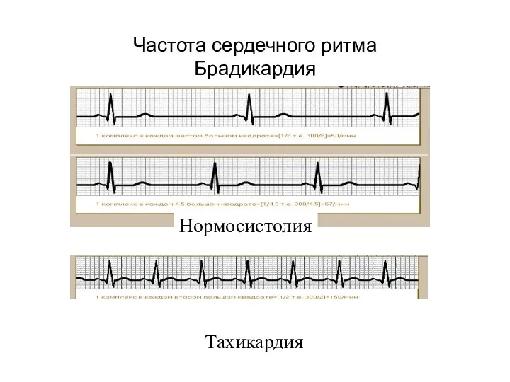 Частота сердечного ритма Брадикардия Тахикардия Нормосистолия