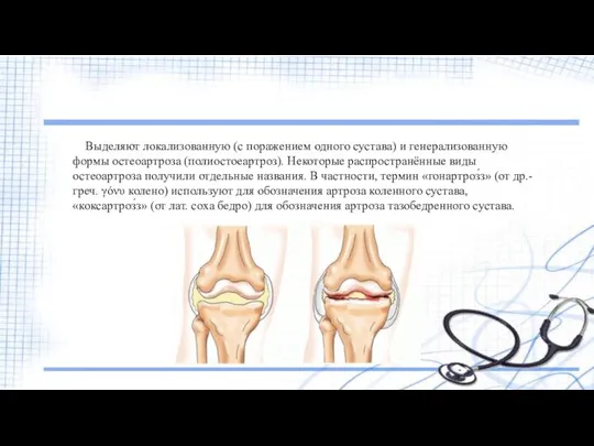 Выделяют локализованную (с поражением одного сустава) и генерализованную формы остеоартроза