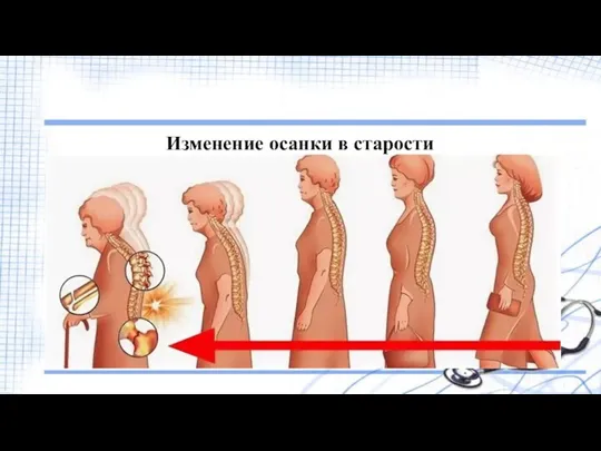 Изменение осанки в старости