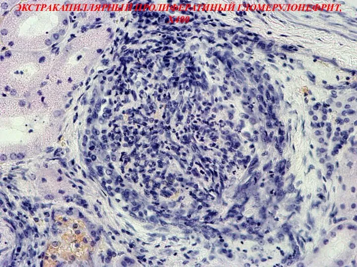 ЭКСТРАКАПИЛЛЯРНЫЙ ПРОЛИФЕРАТИНЫЙ ГЛОМЕРУЛОНЕФРИТ, Х400
