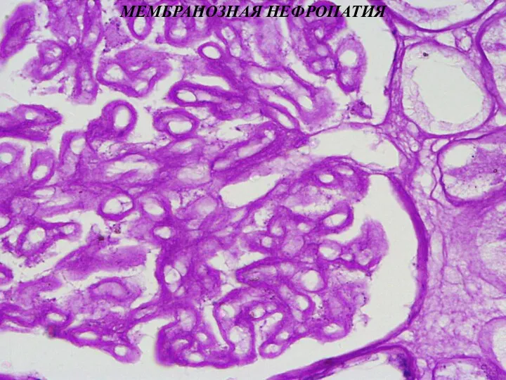 МЕМБРАНОЗНАЯ НЕФРОПАТИЯ