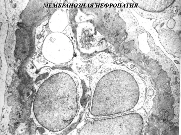 МЕМБРАНОЗНАЯ НЕФРОПАТИЯ