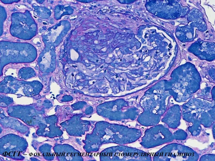 ФСГГ – ФОКАЛЬНЫЙ СЕГМЕНТАРНЫЙ ГЛОМЕРУЛЯРНЫЙ ГИАЛИНОЗ