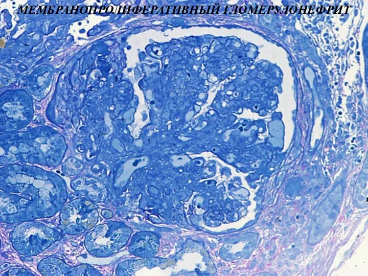 МЕМБРАНОПРОЛИФЕРАТИВНЫЙ ГЛОМЕРУЛОНЕФРИТ