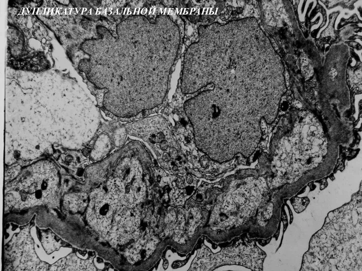 ДУПЛИКАТУРА БАЗАЛЬНОЙ МЕМБРАНЫ