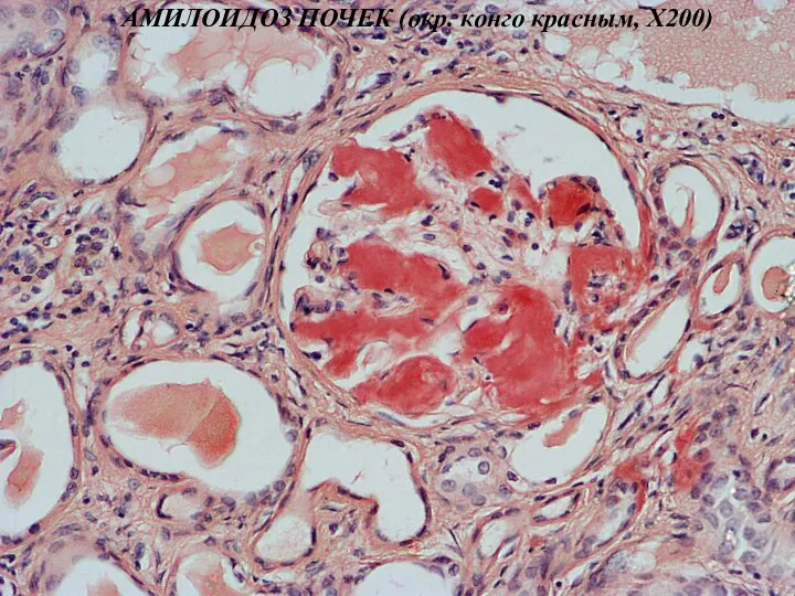 АМИЛОИДОЗ ПОЧЕК (окр. конго красным, Х200)