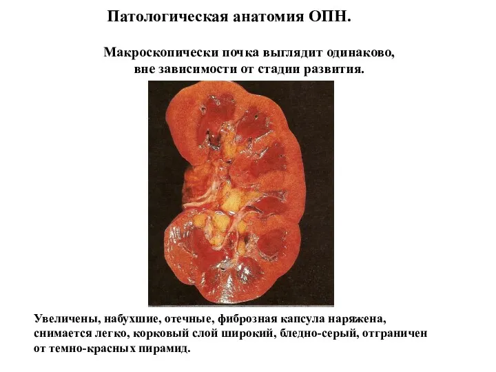 Патологическая анатомия ОПН. Макроскопически почка выглядит одинаково, вне зависимости от