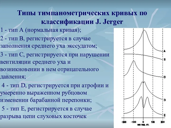 Типы тимпанометрических кривых по классификации J. Jerger 1 - тип