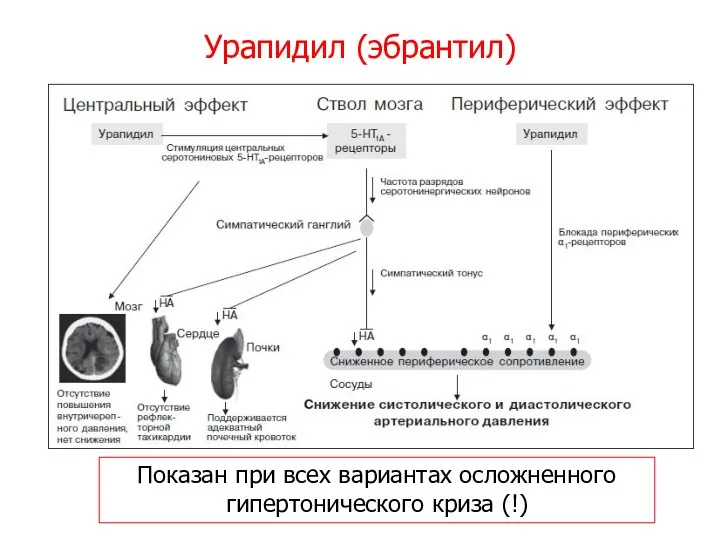 Урапидил (эбрантил) Показан при всех вариантах осложненного гипертонического криза (!)