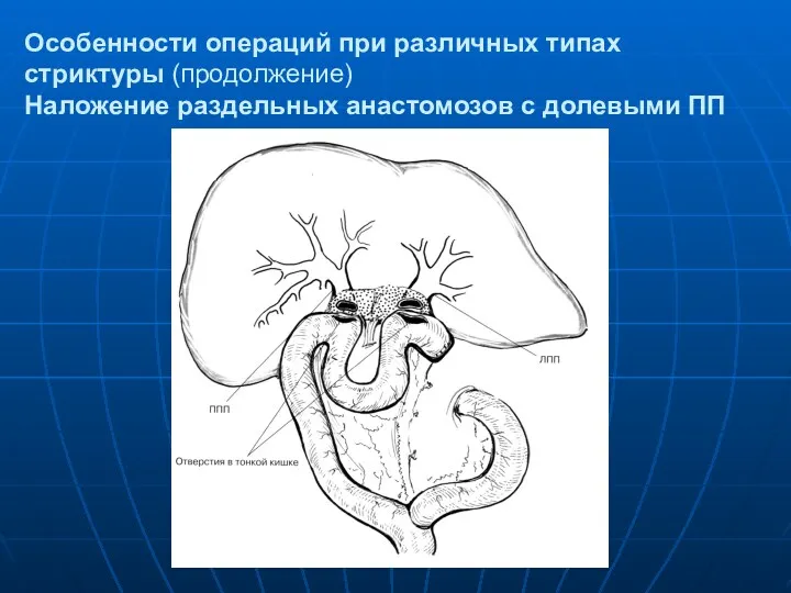 Особенности операций при различных типах стриктуры (продолжение) Наложение раздельных анастомозов с долевыми ПП