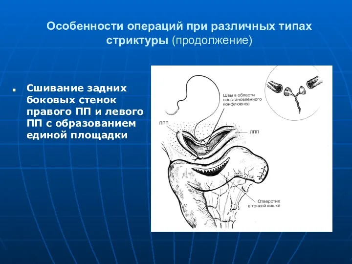 Особенности операций при различных типах стриктуры (продолжение) Сшивание задних боковых