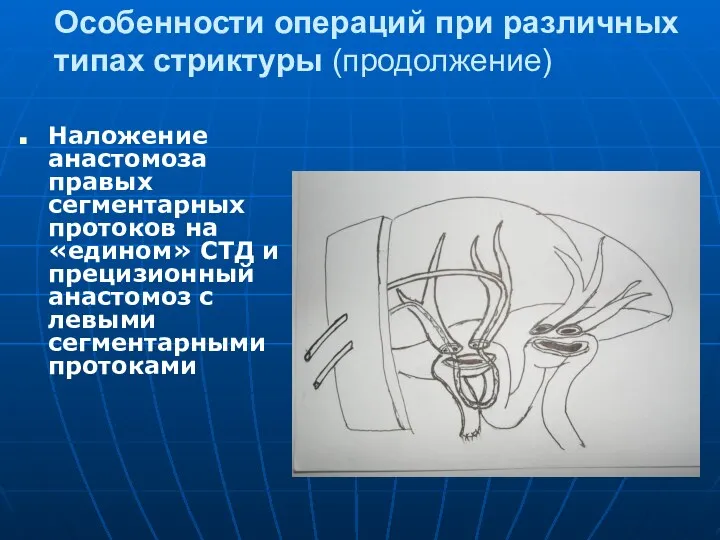 Особенности операций при различных типах стриктуры (продолжение) Наложение анастомоза правых