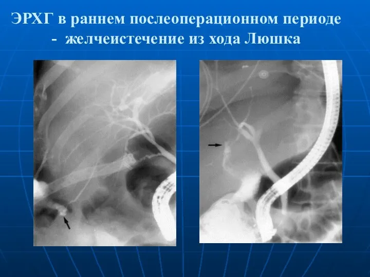 ЭРХГ в раннем послеоперационном периоде - желчеистечение из хода Люшка