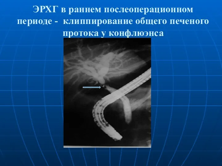 ЭРХГ в раннем послеоперационном периоде - клиппирование общего печеного протока у конфлюэнса