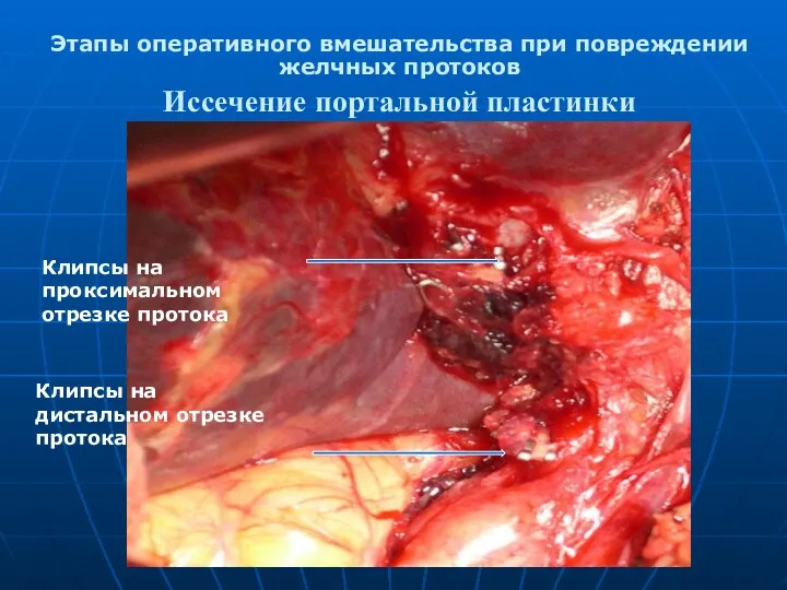 Этапы оперативного вмешательства при повреждении желчных протоков Иссечение портальной пластинки