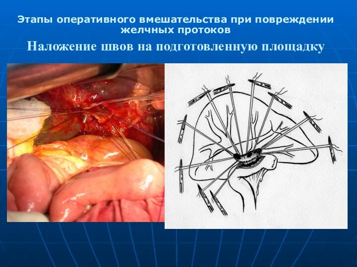 Этапы оперативного вмешательства при повреждении желчных протоков Наложение швов на подготовленную площадку