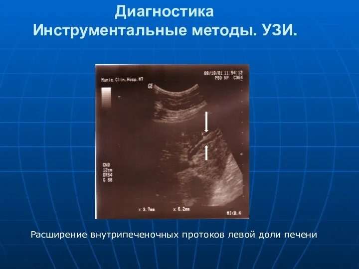 Диагностика Инструментальные методы. УЗИ. Расширение внутрипеченочных протоков левой доли печени