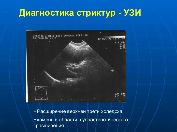 Диагностика стриктур - УЗИ Расширение верхней трети холедоха камень в области супрастенотического расширения