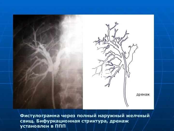 Фистулограмма через полный наружный желчный свищ. Бифуркационная стриктура, дренаж установлен в ППП дренаж