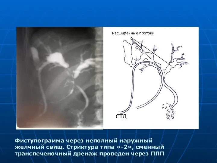 Фистулограмма через неполный наружный желчный свищ. Стриктура типа «-2», сменный