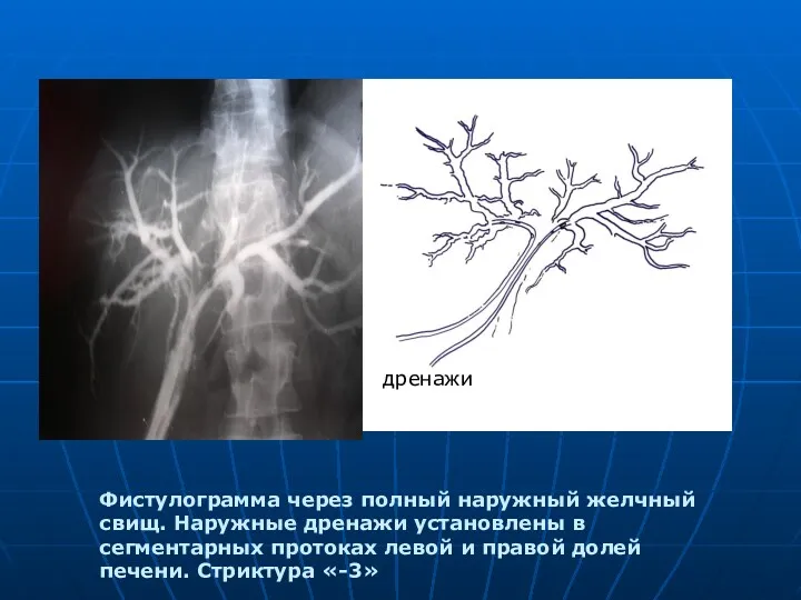 Фистулограмма через полный наружный желчный свищ. Наружные дренажи установлены в