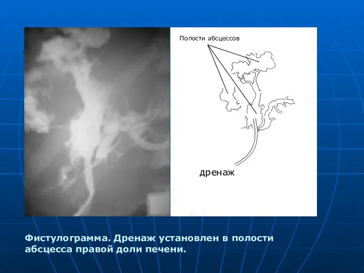 Фистулограмма. Дренаж установлен в полости абсцесса правой доли печени. дренаж Полости абсцессов