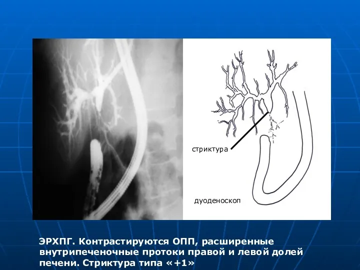 ЭРХПГ. Контрастируются ОПП, расширенные внутрипеченочные протоки правой и левой долей печени. Стриктура типа «+1» дуоденоскоп стриктура