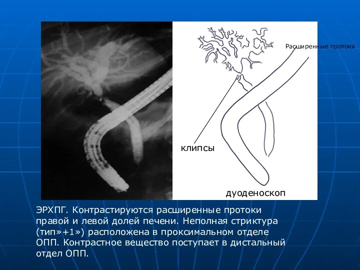 ЭРХПГ. Контрастируются расширенные протоки правой и левой долей печени. Неполная