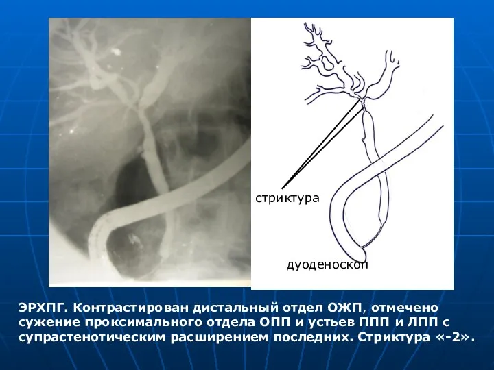 ЭРХПГ. Контрастирован дистальный отдел ОЖП, отмечено сужение проксимального отдела ОПП