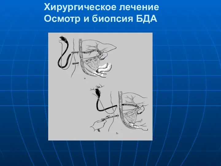 Хирургическое лечение Осмотр и биопсия БДА