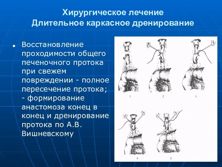 Хирургическое лечение Длительное каркасное дренирование Восстановление проходимости общего печеночного протока