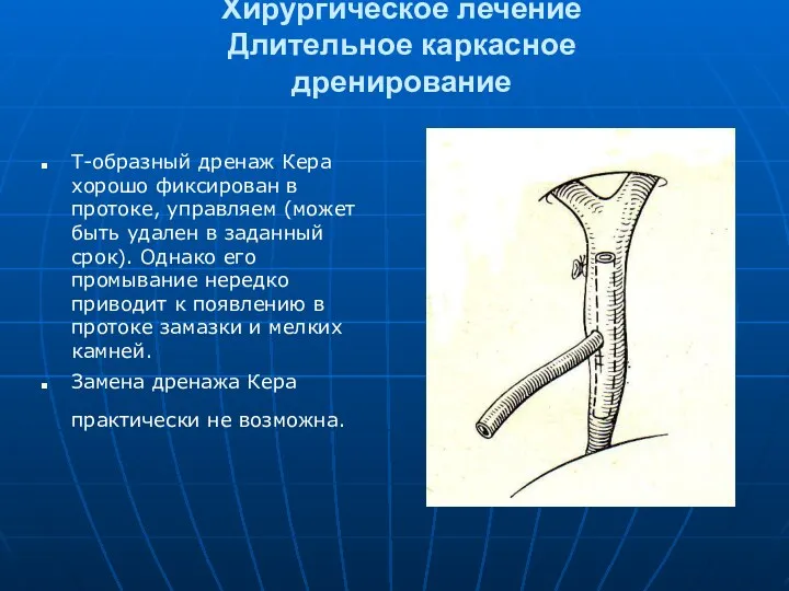 Хирургическое лечение Длительное каркасное дренирование Т-образный дренаж Кера хорошо фиксирован