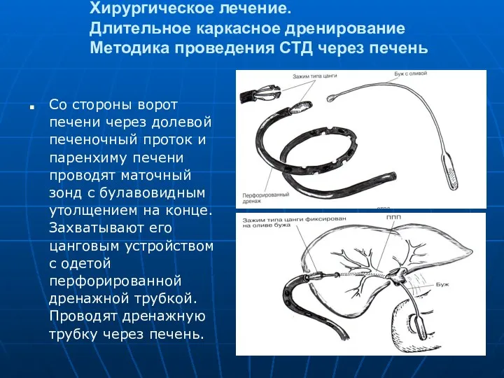 Хирургическое лечение. Длительное каркасное дренирование Методика проведения СТД через печень