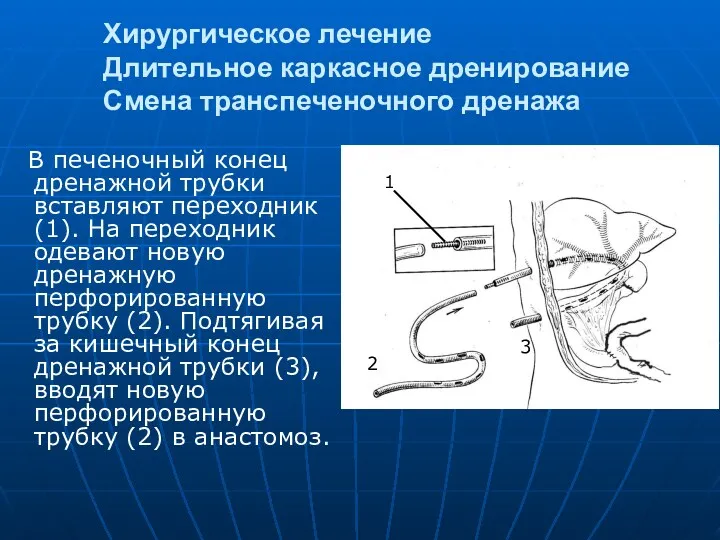 Хирургическое лечение Длительное каркасное дренирование Смена транспеченочного дренажа В печеночный