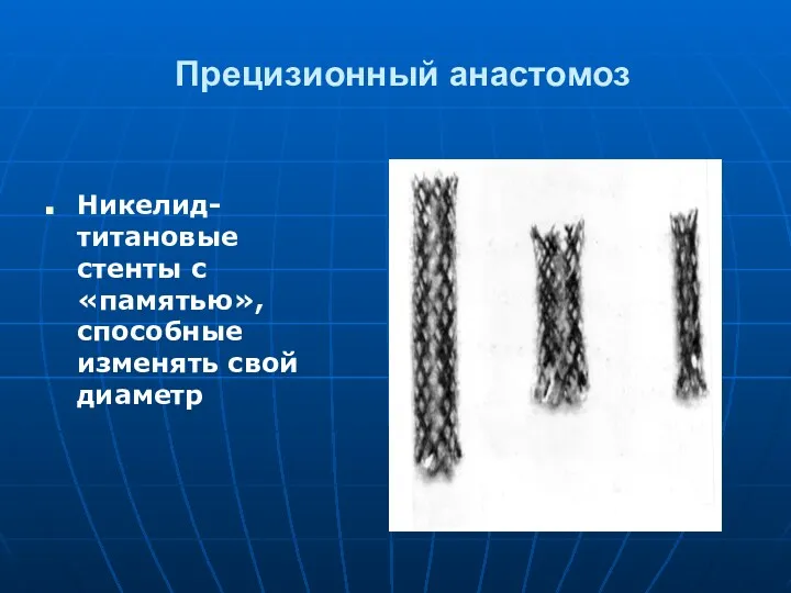 Прецизионный анастомоз Никелид-титановые стенты с «памятью», способные изменять свой диаметр