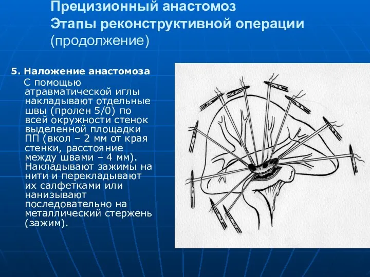 Прецизионный анастомоз Этапы реконструктивной операции (продолжение) 5. Наложение анастомоза С