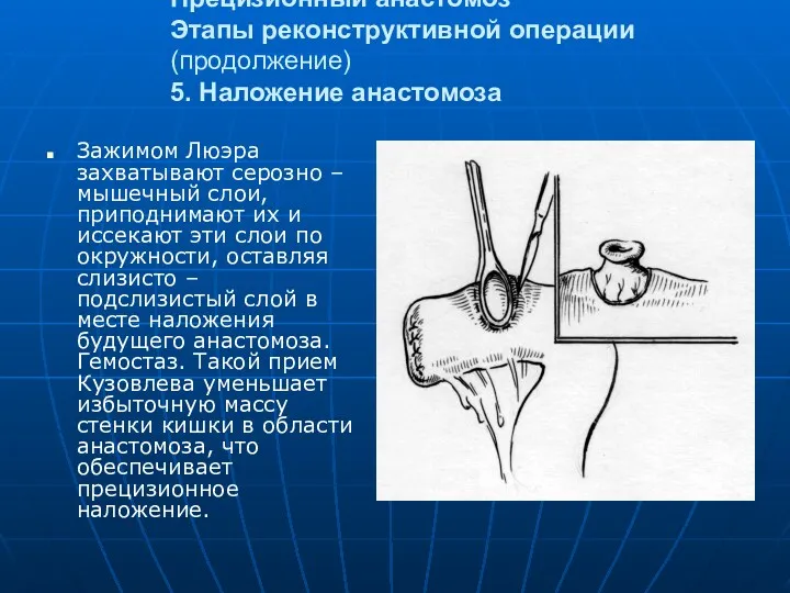 Прецизионный анастомоз Этапы реконструктивной операции (продолжение) 5. Наложение анастомоза Зажимом