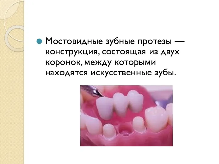 Мостовидные зубные протезы — конструкция, состоящая из двух коронок, между которыми находятся искусственные зубы.