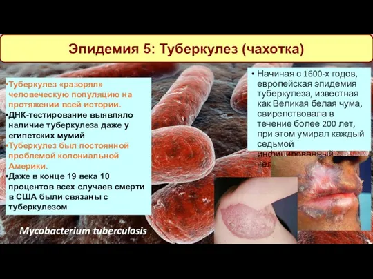 Эпидемия 5: Туберкулез (чахотка) Туберкулез «разорял» человеческую популяцию на протяжении