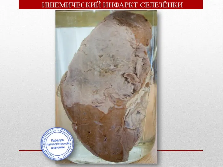 ИШЕМИЧЕСКИЙ ИНФАРКТ СЕЛЕЗЁНКИ