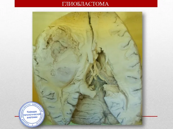 ГЛИОБЛАСТОМА