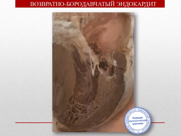 ВОЗВРАТНО-БОРОДАВЧАТЫЙ ЭНДОКАРДИТ