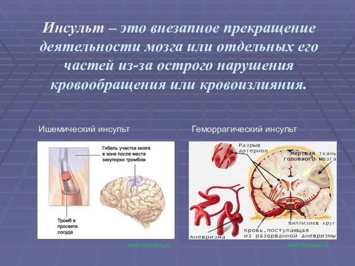 Инсульт – это внезапное прекращение деятельности мозга или отдельных его