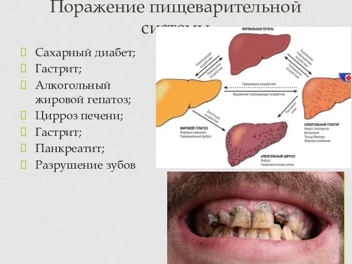 Сахарный диабет; Гастрит; Алкогольный жировой гепатоз; Цирроз печени; Гастрит; Панкреатит; Разрушение зубов Поражение пищеварительной системы