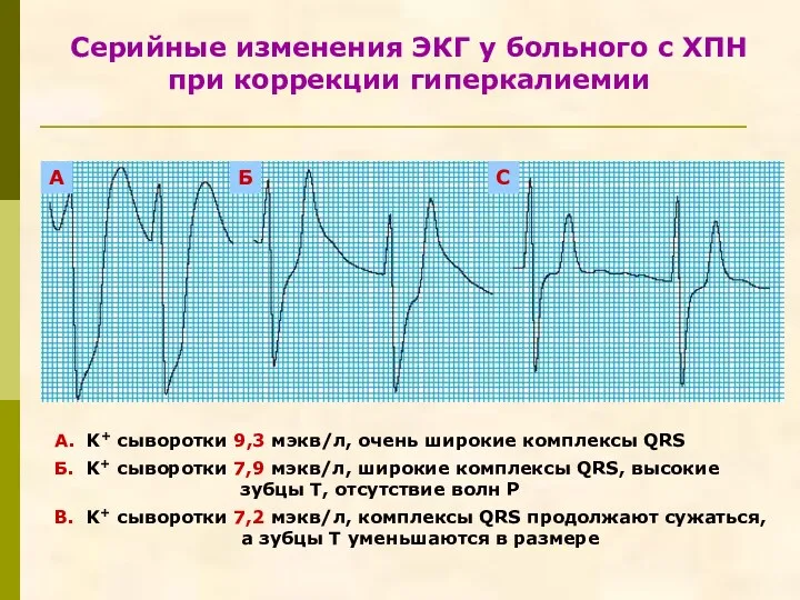 Серийные изменения ЭКГ у больного с ХПН при коррекции гиперкалиемии A. K+ сыворотки